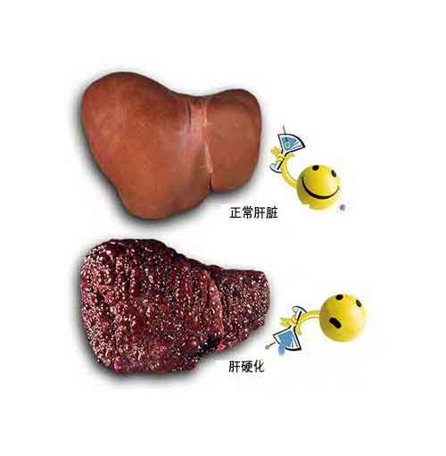 郑州治疗肝硬化去哪个医院?郑州哪家医院专治肝硬化