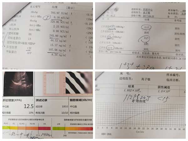 河南省内看乙肝哪个医院值得信任